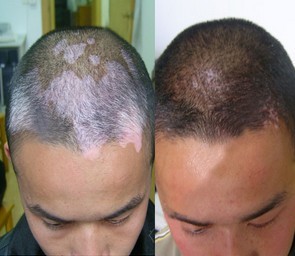 长春博润白癜风医院