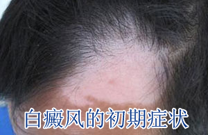 白癜风发病时有什么症状