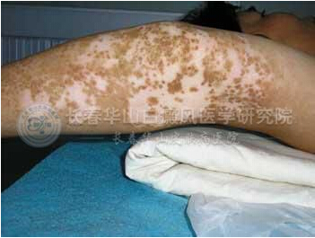 哪些因素导致白癜风复发